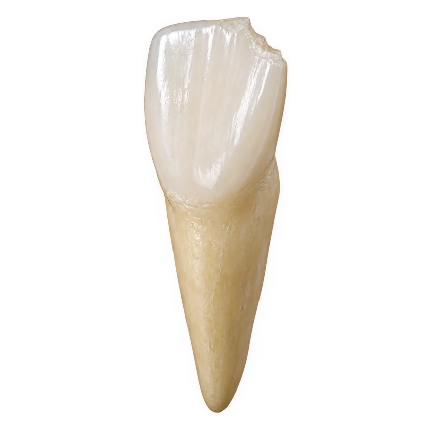 Front tooth with a chipped corner