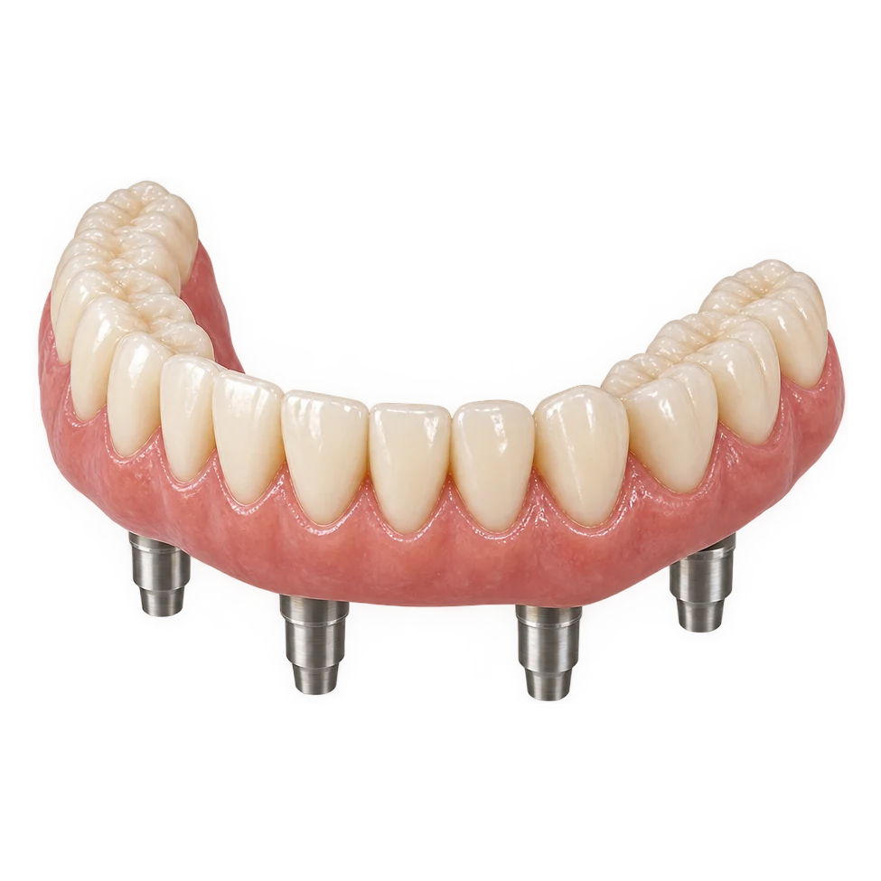 Full lower denture supported by four dental implants