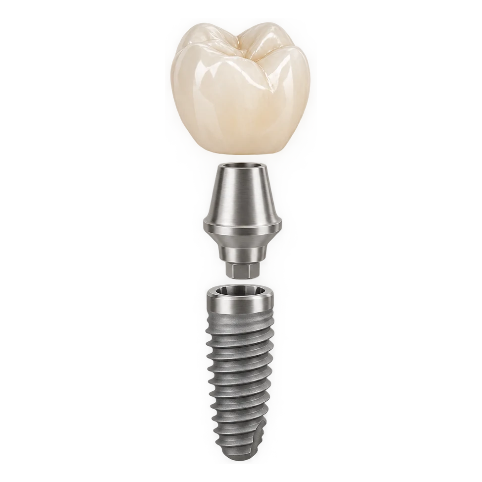 Dental implant, abutment and crown in an exploded view