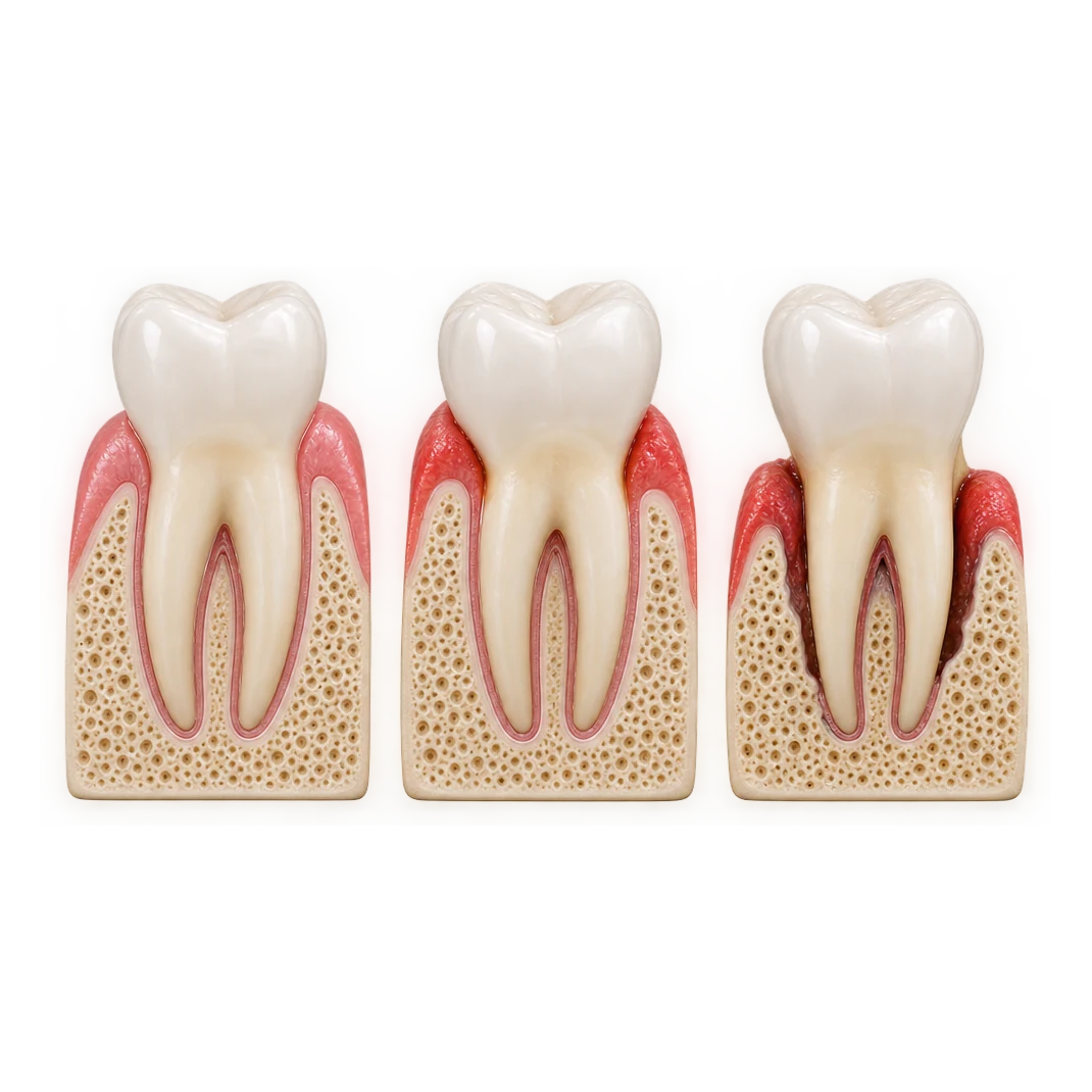 Three tooth cross-sections showing the stages of periodontal disease